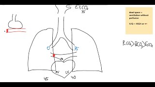 PE as it pertains to arrest, dead space, hypoxemia