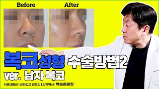 남자복코성형 전후 궁금하신분?? | 남자복코수술 사례 별 수술방법 알려드릴게요! 😎 - 백승준