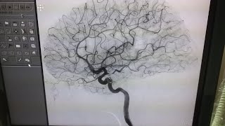 Cerebral Angiography