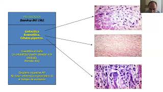 7  el paciente con miocarditis y miocardiopatias