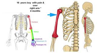 Humerus or Shoulder or Arm bone Tumor  Surgery