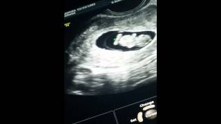 8 week ultrasound