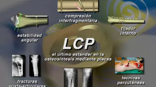 Osteosíntesis - Principios placa LCP "Locking compresión plate"