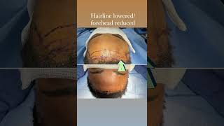 Hairline lowering surgery #hairlinelowering