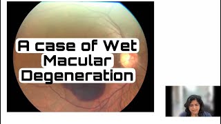 A case of Wet Macular Degeneration/ #maculardegeneration