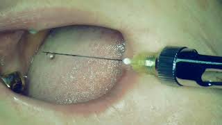 Infiltration anesthesia technique for implantation missing 1.6 teeth.