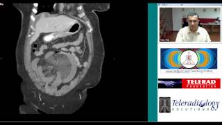 Superior Mesenteric Vein Thrombosis by Dr Arjun Kalyanpur