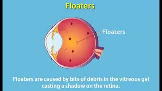 Symptoms of Retinal Detachment -  - Mr Mahi Muqit PhD FRCOphth