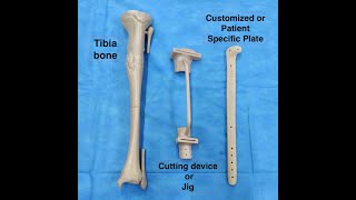 3 D Printed Bone model and Customised Plate