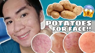 PATATAS!! EFFECTIVE PANGTANGGAL PEKAS, DARKSPOT, BLEMISHES ATBP!!😱