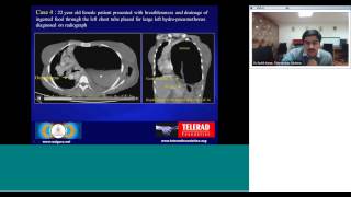 CT Imaging of Gastrointestinal Tract Volvulus by Dr Savith Kumar