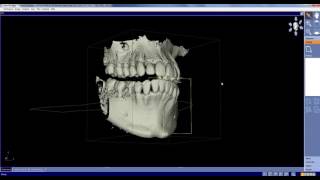 Galileos Implant software highlight soft tissue, and crop upper or lower jaw.