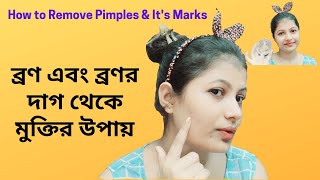 ব্রণ এবং ব্রণর দাগ থেকে মুক্তির উপায় কী?How to remove acne/pimples and acne spots?#acne #pimples