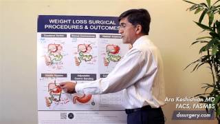 Weight Loss Surgical Procedures Part 7 - Summary