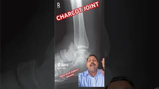 Charcot joint