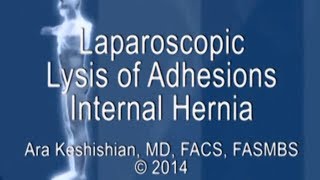 Laparoscopic Lysis of Adhesions - Internal Hernia