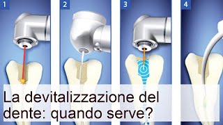 La devitalizzazione del dente: quando serve?