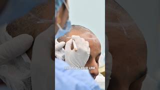 Hair Transplant Result After 10 Days - Hassan Hair Transplant Experience