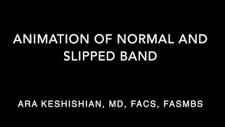 Normal and Slipped Band