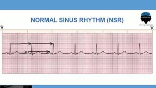 Ritmo Sinusal Normal + Calculo de Frecuencia Cardiaca