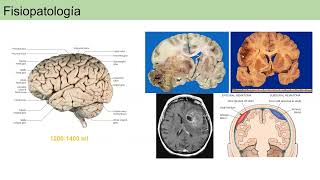 Hipertensión endocraneana Marino