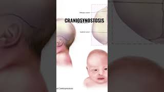 craniosynostosis