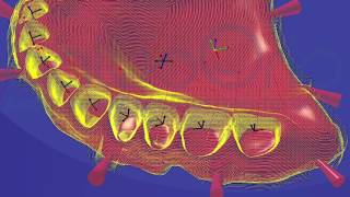 Full digital denture: leading the way