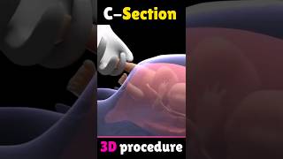 C-Section #shorts