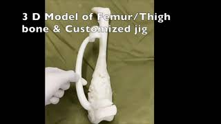 3D Printed  Bone model  and Jig used in Bone cancer surgery