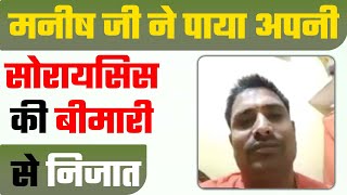 सोरायसिस हुआ 2 महीने में ठीक | Psoriasis Recovery | Best Psoriasis Treatment | How to cure psoriasis