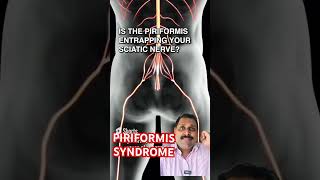 PIRIFORMIS syndrome