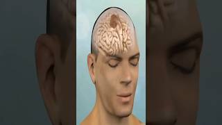 Brain Tumor 3D animation video Human body #Sho