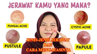 JENIS-JENIS JERAWAT DAN CARA MENGATASINYA