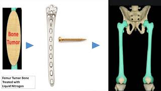 3D Printing in Orthopaedic Oncology: Patient education video