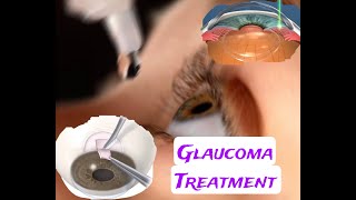 Latest treatment for GLAUCOMA/ #glaucoma #eyedrops