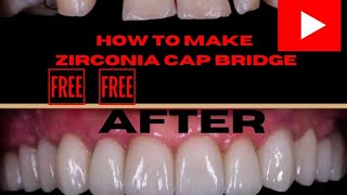 #live #video zirconia crown bridge 🦷