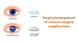 Diabetic Eye Disease Surgery By Mahi Muqit