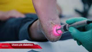 Cicatrización de heridas y úlceras de pie diabético con K-Laser Cube