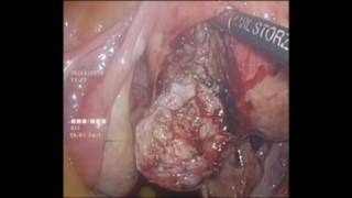 laparoscopy myomectomy