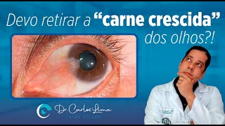 Devo retirar a "carne crescida" dos olhos?!