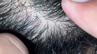 ASMR barbersurgion bearding hairandbeard | ingrown 10 ingrown