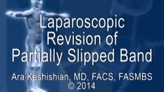 Laparoscopic Revision of Partially Slipped Band