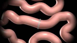 Duodenal Switch Animation