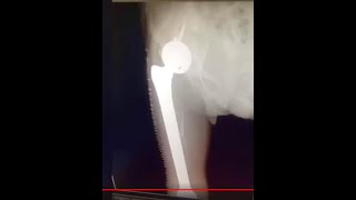 Total Femur or Thigh Bone Replacement surgery : Hip Joint & Knee Joint and Femur Bone Surgery