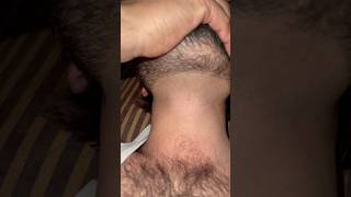 Ingrown hairs #barber #hairsalon #barbersurgion #hairstyle #beard