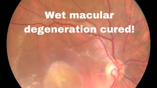 A case of wet macular degeneration cured