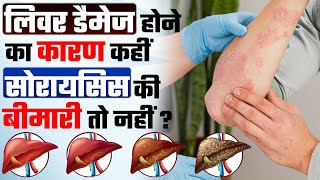 लिवर सोरायसिस क्या होता है | Skin disease | क्या सोरायसिस की बीमारी से लिवर डैमेज हो जाता है ?