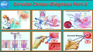 Cervical Cancer Symptoms, Causes, Types , Stages of cancer, Risk factor, Diagnosis,Treatment Part 5