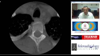 Radiology Teaching on Cervical Spine CT by Dr ArjunKalyanpur