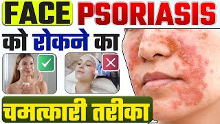 Face psoriasis | फेस सोरायसिस को रोकने का चमत्कारी तरीका | Psoriasis on face